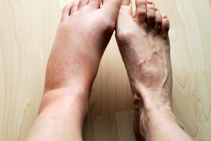 Swollen foot compared with normal foot showing edema, a possible symptom of kidney disease