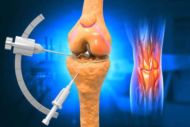 Medical illustration of a knee joint undergoing minimally invasive surgery with instruments inserted to treat damaged cartilage and reduce inflammation and pain.