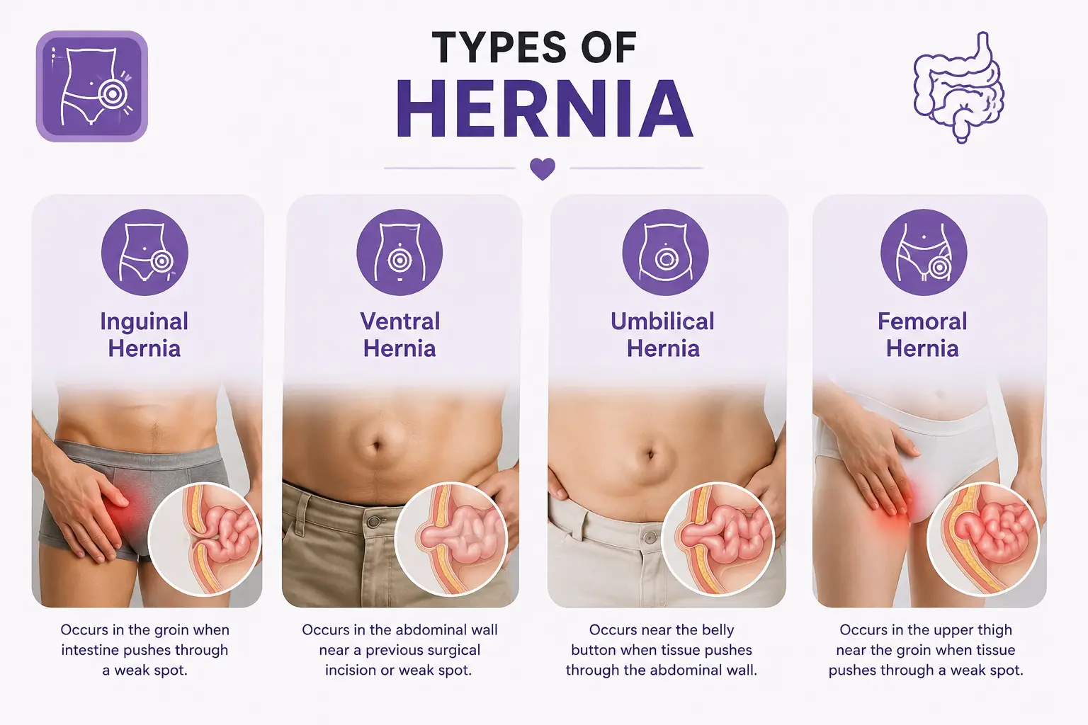 Types of Hernia